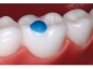 Preview: Reliamold™, Pad Tips pentru molari