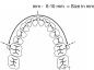 Preview: Arc de distalizare molară, kit (mărimea 1-7) (80 - 98 mm)