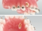 Preview: Butoni ortodontici cu lant din aur