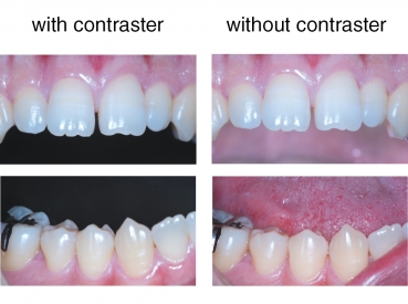 Contraster, anterior L