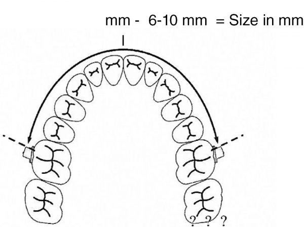 Arc de distalizare molară, kit (mărimea 1-7) (80 - 98 mm)