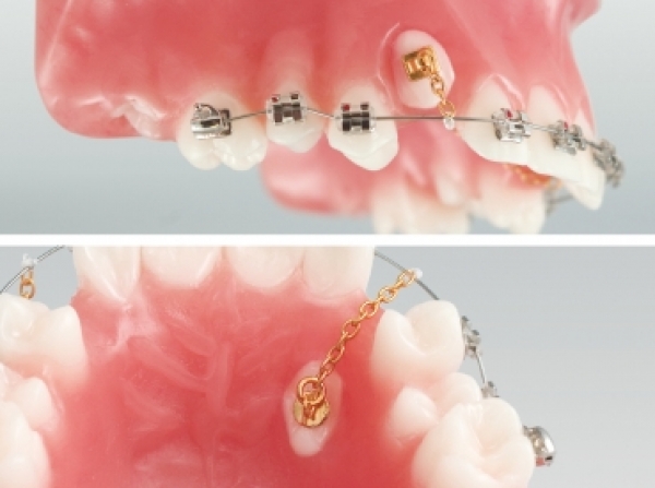 Butoni ortodontici cu lant din aur
